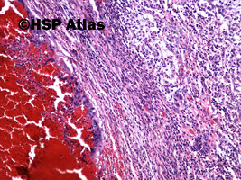 4. Mixed germ cell tumor - embryonal carcinoma, choriocarcinoma, 10x