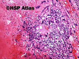 5. Mixed germ cell tumor - choriocarcinoma, 10x