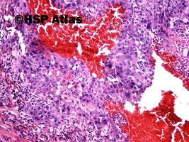 6. Mixed germ cell tumor - choriocarcinoma, 10x