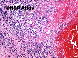 7. Mixed germ cell tumor - choriocarcinoma, 10x