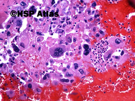 9. Mixed germ cell tumor - choriocarcinoma, 20x