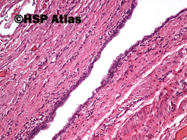 2. Torbiel śluzowa (mucoid cyst), 10x