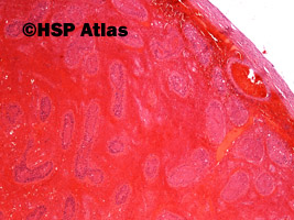 1. Skręt jądra - martwica krwotoczna (testicular torsion - hemorrhagic necrosis), 4x