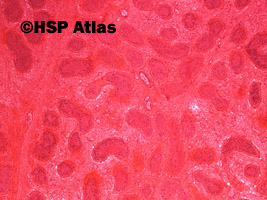 2. Skręt jądra - martwica krwotoczna (testicular torsion - hemorrhagic necrosis), 4x