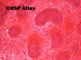 3. Skręt jądra - martwica krwotoczna (testicular torsion - hemorrhagic necrosis), 10x