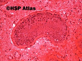 4. Skręt jądra - martwica krwotoczna (testicular torsion - hemorrhagic necrosis), 20x