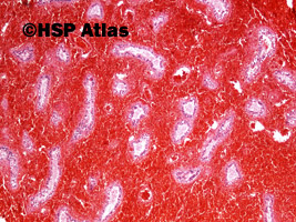 5. Skręt jądra - martwica krwotoczna (testicular torsion - hemorrhagic necrosis), 4x