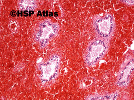 6. Skręt jądra - martwica krwotoczna (testicular torsion - hemorrhagic necrosis), 10x