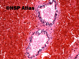 7. Skręt jądra - martwica krwotoczna (testicular torsion - hemorrhagic necrosis), 20x