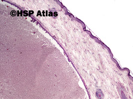 1. Apokrynowy torbielak potowy (Apocrine hidrocystoma), 4x