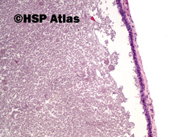 2. Apokrynowy torbielak potowy (Apocrine hidrocystoma), 10x