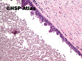 4. Apokrynowy torbielak potowy (Apocrine hidrocystoma), 20x