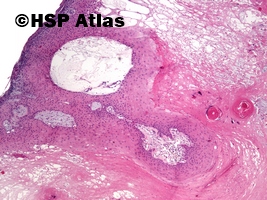 1. Proliferująca torbiel włosowa (pilar tumor, proliferating trichilemmal cyst), 4x