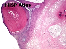 2. Proliferująca torbiel włosowa (pilar tumor, proliferating trichilemmal cyst), 4x