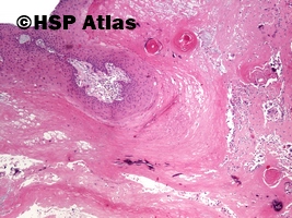 3. Proliferująca torbiel włosowa (pilar tumor, proliferating trichilemmal cyst), 4x