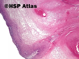 4. Proliferująca torbiel włosowa (pilar tumor, proliferating trichilemmal cyst), 4x