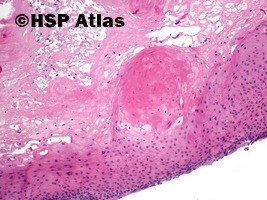 6. Proliferująca torbiel włosowa (pilar tumor, proliferating trichilemmal cyst), 10x