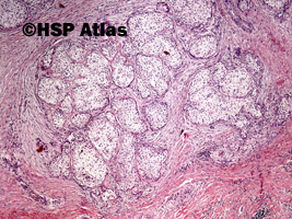 1. Rak łojowy (Sebaceous carcinoma), 4x