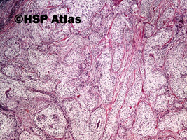4. Rak łojowy (Sebaceous carcinoma), 4x
