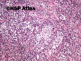 7. Rak łojowy (Sebaceous carcinoma), 10x