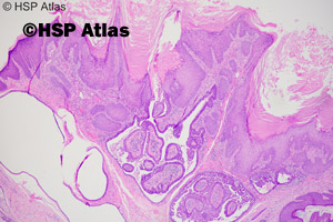 1. Brodawkowaty gruczolakotorbielak apokrynowy w znamieniu łojowym (syringocystadenoma papilliferum in sebaceous nevus)