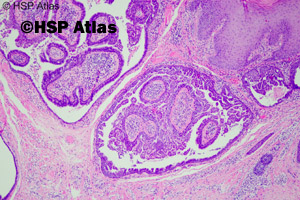 2. Brodawkowaty gruczolakotorbielak apokrynowy w znamieniu łojowym (syringocystadenoma papilliferum in sebaceous nevus)