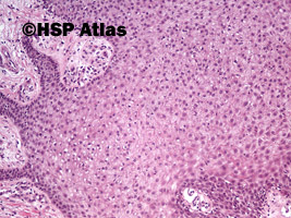 3. Rogowiak jasnokomórkowy (clear cell acanthoma), 10x