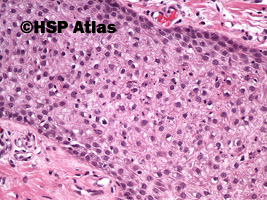 5. Clear cell acanthoma, 20x