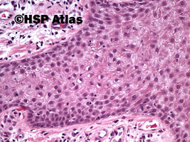 6. Rogowiak jasnokomórkowy (clear cell acanthoma), 20x