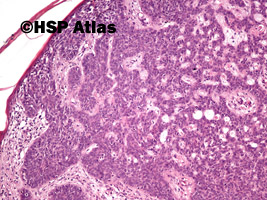 5. Basal cell carcinoma, 10x