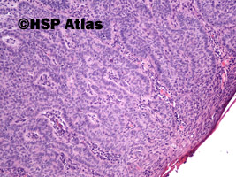 6. Rak podstawnokomórkowy (basal cell carcinoma), 10x