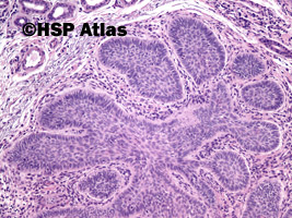 7. Rak podstawnokomórkowy (basal cell carcinoma), 10x