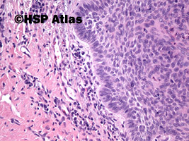 8. Basal cell carcinoma, 20x
