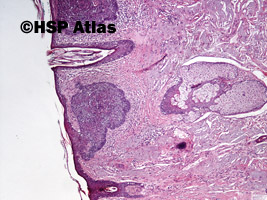 1. Rak podstawnokomórkowy, typ powierzchowny (basal cell carcinoma, superficial variant), 4x