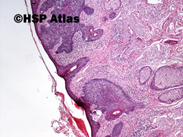 2. Rak podstawnokomórkowy, typ powierzchowny (basal cell carcinoma, superficial variant), 4x