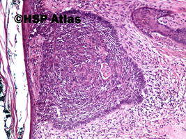 3. Rak podstawnokomórkowy, typ powierzchowny (basal cell carcinoma, superficial variant), 10x