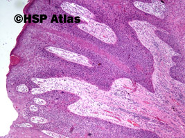 1. Rak śródnaskórkowy Bowena - in situ (intraepidermal squamous-cell carcinoma - in situ), 4x