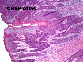 2. Intraepidermal squamous-cell carcinoma - in situ, 4x
