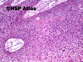 4. Rak śródnaskórkowy Bowena - in situ (intraepidermal squamous-cell carcinoma - in situ), 10x