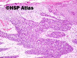 5. Rak śródnaskórkowy Bowena - in situ (intraepidermal squamous-cell carcinoma - in situ), 10x