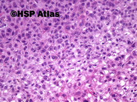 7. Rak śródnaskórkowy Bowena - in situ (intraepidermal squamous-cell carcinoma - in situ), 20x