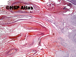 1. Rak brodawczakowaty (verrucous carcinoma), 4x
