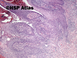 4. Rak brodawczakowaty (verrucous carcinoma), 4x