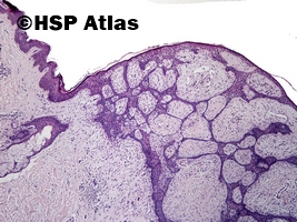 1. Włókniakonabłoniak, guz Pinkusa (fibroepithelioma, Pinkus' tumor), 4x