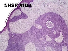 2. Fibroepithelioma (Pinkus' tumor), 4x