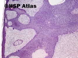 3. Włókniakonabłoniak, guz Pinkusa (fibroepithelioma, Pinkus' tumor), 4x