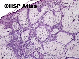 4. Włókniakonabłoniak, guz Pinkusa (fibroepithelioma, Pinkus' tumor), 10x