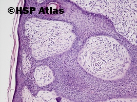 5. Fibroepithelioma (Pinkus' tumor), 10x