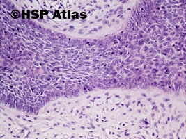 6. Włókniakonabłoniak, guz Pinkusa (fibroepithelioma, Pinkus' tumor), 20x