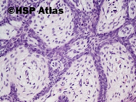 7. Włókniakonabłoniak, guz Pinkusa (fibroepithelioma, Pinkus' tumor), 20x